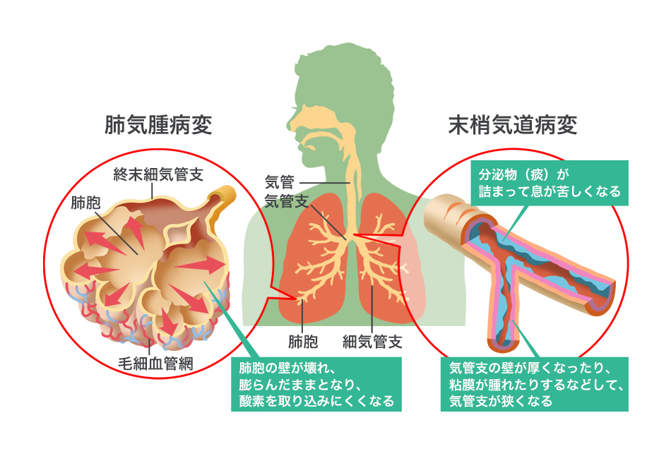 Copdの基礎 Treatabletraits Jp